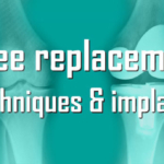 Latest Technology in Knee Replacement Surgery